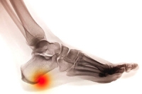 Heel Spur Information