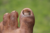 Understanding Onychomycosis and Nail Health