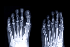 Understanding Fifth Metatarsal Fractures