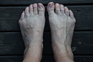 What to Know About Bunionette Deformity