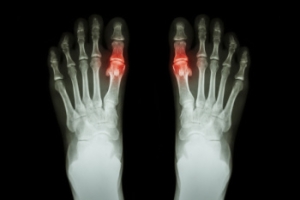 Understanding Common Causes of Gout